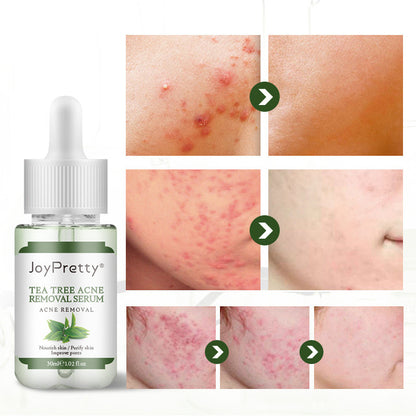 Bouteille de soin visage Fade Acne Marks et Acne Tea Tree, flacon de 0, visible avec étiquette et pompe.